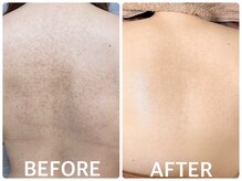 ハーブピーリング 心斎橋/背中ニキビ改善