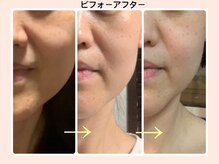 リファイン(REFINE)/肌別美容液導入、すっきり小顔へ