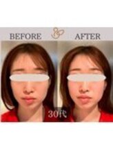 チョコバリ 錦糸町店(chocobari)/小顔×リフトアップ(美容鍼)30代