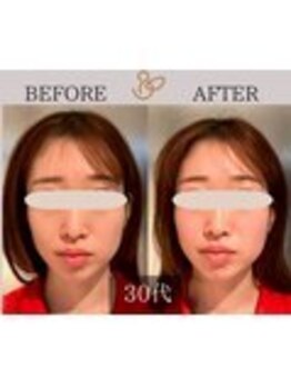 チョコバリ 錦糸町店(chocobari)/小顔×リフトアップ(美容鍼)30代