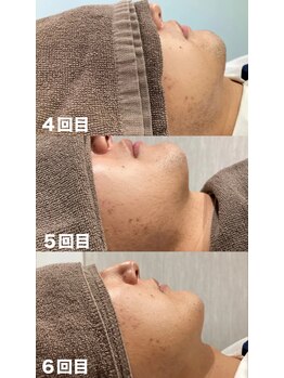 ビューティーサロンレモン(Lemon)/髭脱毛4~6回目