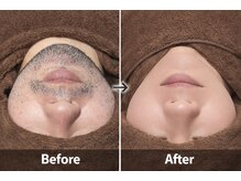 ヨハク(YOHAKU)/20代後半　男性　９回施術