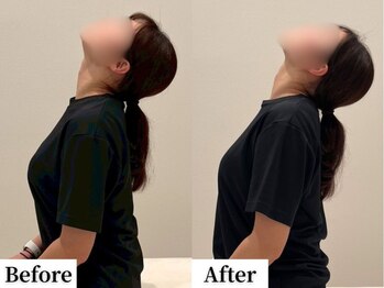 ソレア(Solea)/首こり・巻き肩改善1回目