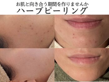 ジプソフィラフィフティドット(gypsophira15.)の写真/ノンケミカル・国産・他とは違う剥けるだけが目的ではないハーブピーリングで繰り返すお悩みにさよならを
