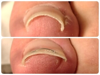 フットケアサロン ラビフット(Rabbi foot)の写真/【巻き爪矯正◇フットケア専門店】最適な施術をご提案し、快適な足元へ導きます！