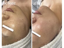 サロン ド ビューティージュエル(salon de beauty JEWEL)/プラズマニア【2回】