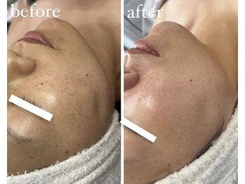 サロン ド ビューティージュエル(salon de beauty JEWEL)/プラズマニア【2回】