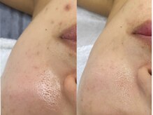 ホーミー(Homie)/ニキビ改善、赤みニキビ改善