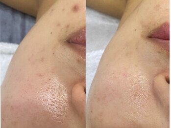 ホーミー(Homie)/ニキビ改善、赤みニキビ改善