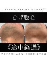 サロン イニ(SALON INI)/《ひげ脱毛途中経過》