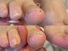 キラネイル アンド アイラッシュ by World Beauty(KIRA)/新潟巻爪