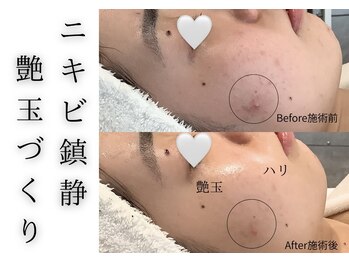 チッチ アフロディーテ(Chicchi Aphrodit)/ハーブピーリング 