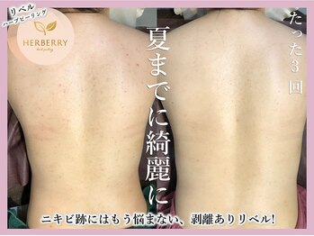 ハーバリー 天王寺(HERBERRY)/ハーブピーリング専門店HERBERRY