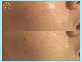 ハーブピーリング 名古屋/TETEピールで毛穴改善！