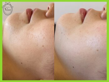 ヴィオール 名古屋栄店(VIOR)/剥離無し ニキビケア 肌質改善