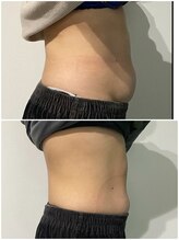 OBS/OBS痩身お腹集中(1回目当日)