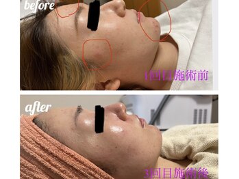 ワイズビューティ(Y’s Beauty)/毛穴フェイシャル