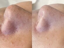 ヴィーヴ 京橋(vive)/【韓国式3D毛穴洗浄】