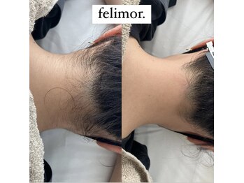フェリモール(Felimor.)/シュガーリングbefore／after