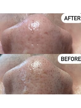 ソーレエルーナ(SOLE e LUNA)/毛穴ケア 眉毛 眉 肌 黒ずみ