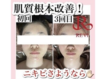 ホワイトアクア 池袋店(WHITE AQUA)/ハーブピーリング/毛穴洗浄/池袋