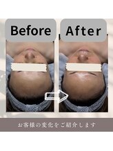 ケーブロッサムビューティーサロン(K Blossom Beauty Salon)/水光３Dピール(ビフォ.アフター)