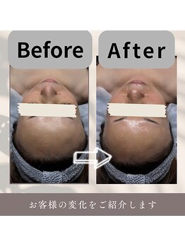 ケーブロッサムビューティーサロン(K Blossom Beauty Salon)/水光３Dピール(ビフォ.アフター)