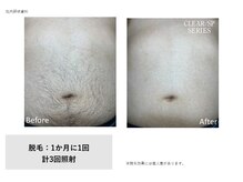ドルチェビューティーサロン 戸塚安行店(Dolce Beauty Salon)/お腹脱毛3回（男性）