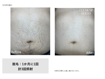 ドルチェビューティーサロン 戸塚安行店(Dolce Beauty Salon)/お腹脱毛3回（男性）