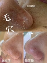 ユヌ(une)/毛穴エクストラクション