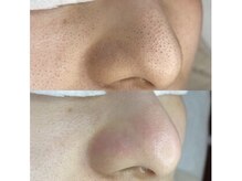 エーアジア(a asia)/角栓ケア！溜まった毛穴の大掃除