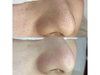 エーアジア(a asia)/角栓ケア！溜まった毛穴の大掃除