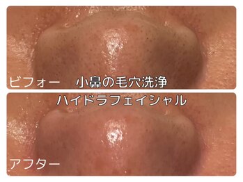 ソワン ド ブランシュ ライフ八戸ノ里店(Soin de Blanche)/小鼻の毛穴洗浄　ハイドラ美顔