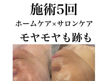 サロンツキ(salon tuki)/【最新フォト症例】施術5回