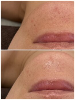 ギャラクシービューティー(galaxy beauty)/ララピールで赤みケア