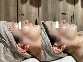 オリス(ORRIS)/ラミネーションピーリング