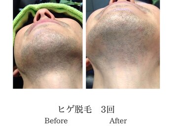 メンズミーシェ(Men's Meshie)/あご裏までしっかり減毛♪