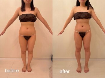 クロレ 浦和店(CLORE)/20代のお客様/18回施術