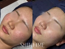 シノノメ(SHINONOME)/＊ニキビケア・ザラつき