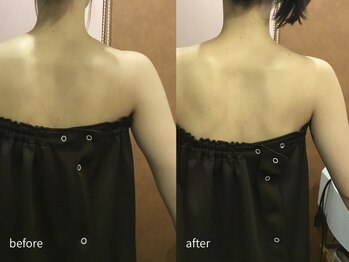 エステティックサロン アールグレー/1か月の変化6回1クール