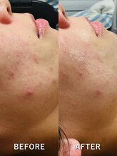 ルーク(Luke)/ニキビケア／くすみ／毛穴