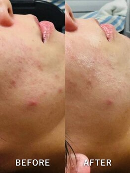 ルーク(Luke)/ニキビケア／くすみ／毛穴