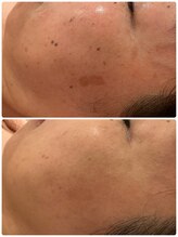 ミラ(Mila)/フォト＋ポレーション1年半