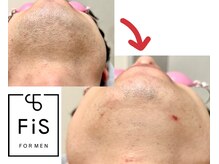 フィズ 経堂店(FIS)/☆脱毛途中経過☆［経堂/脱毛］