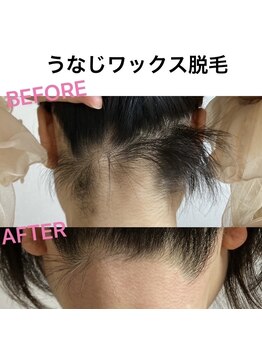 ビジュー(Bijou)/#うなじ美光脱毛