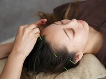 プライムライフ(prime-life)/美容鍼はまず頭皮鍼から