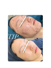 ソリッジ肌管理室/ニキビケア