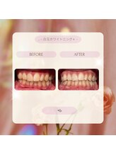プラスビー 2号店(+b)/ホワイトニングビフォーアフター