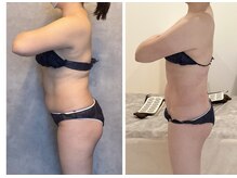 TMサロン 赤坂/なかなか落ちない内臓脂肪も減