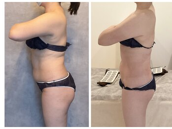 TMサロン 赤坂/なかなか落ちない内臓脂肪も減